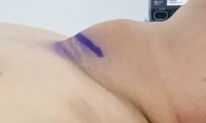 U mỡ và bướu tuyến giáp chèn ép khí quản U mỡ và bướu tuyến giáp chèn ép khí quản