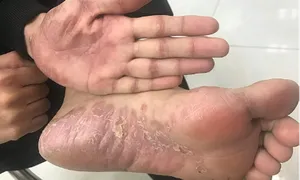 Bị giang mai ở mắt Bị giang mai ở mắt